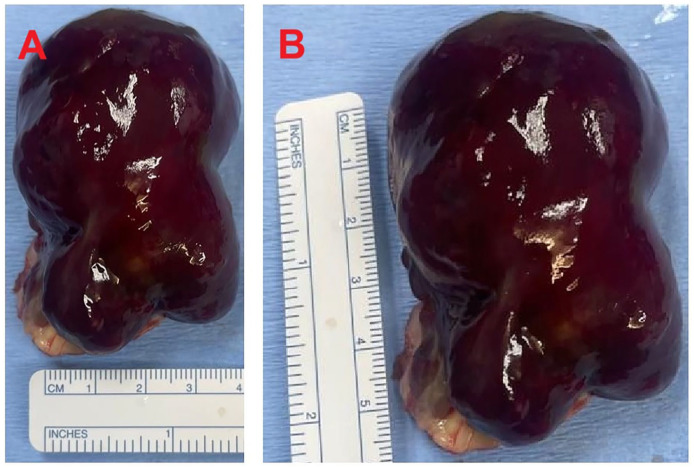 Giant Right Atrial Myxoma Presenting With Right Heart Failure.