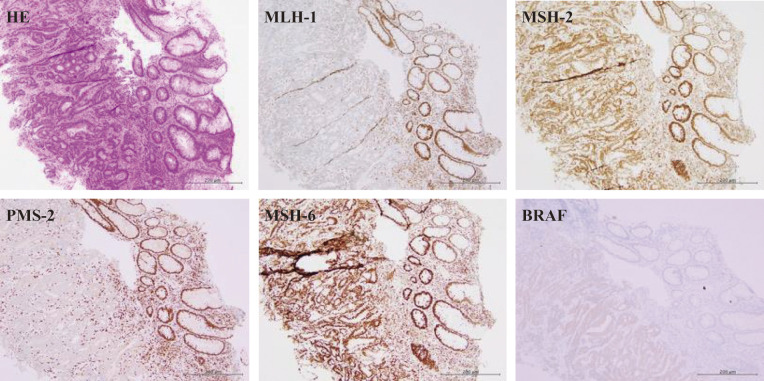 Spontaneous Regression of Advanced Transverse Colon Cancer: A Case Report.