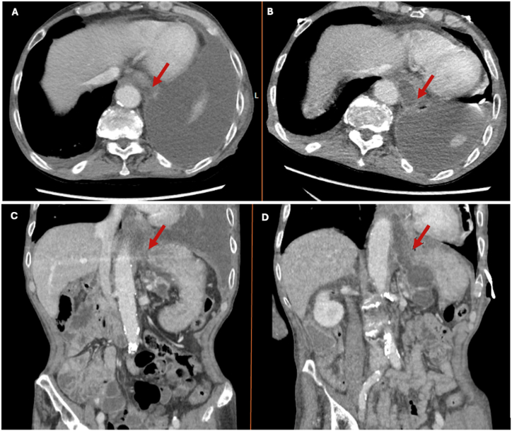 Pancreatopleural fistula: A rare cause of recurrent pleural effusion