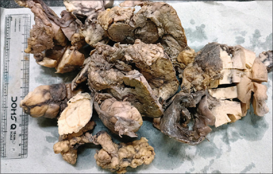 Malignant Perivascular Epithelioid Cell Tumor of Ovary: A Rare Case Report.
