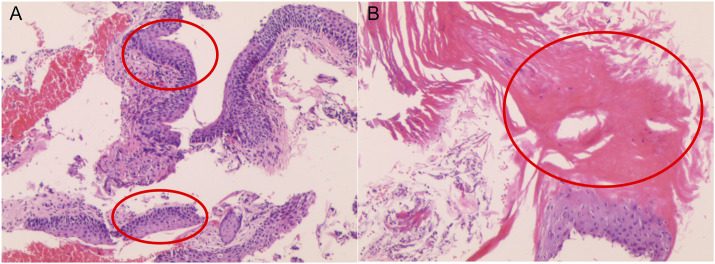 Tracheal mucosal keratosis: Case discussion and literature review.