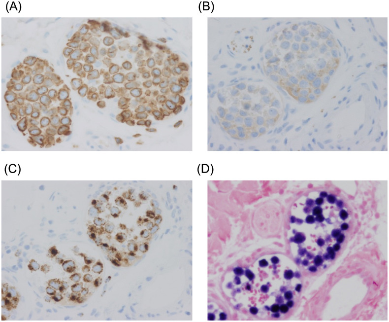 Long-term remission in a patient with NK/T cell intravascular lymphoma with autologous hematopoietic cell transplantation.