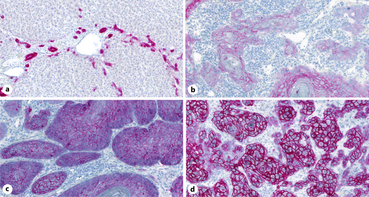 Trop2 Expression in Correlation to the Molecular Subtype in Vulvar Squamous Cell Carcinomas.