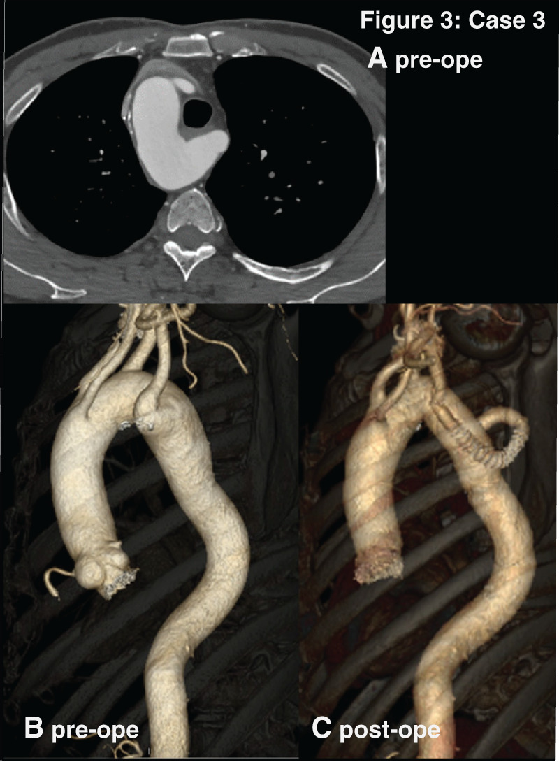 Optimal Surgical Strategy for Kommerell's Diverticulum Associated with a Right-Sided Aortic Arch: A Report of Four Cases.