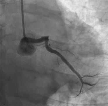Complex Infective Endocarditis: Uncommon Presentations and Their Multisystem Complications - A Case Series.