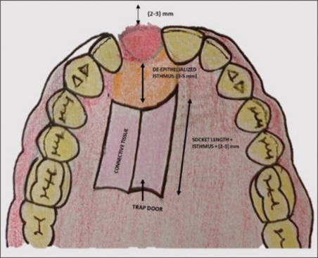 Vascularized interpositional periosteal connective tissue flap: A comprehensive review.