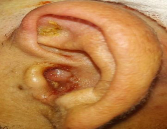Otoscleroma of the Middle Ear and Mastoid Cavity with Facial Palsy: A Case Report.