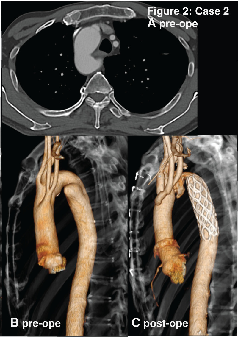 Optimal Surgical Strategy for Kommerell's Diverticulum Associated with a Right-Sided Aortic Arch: A Report of Four Cases.