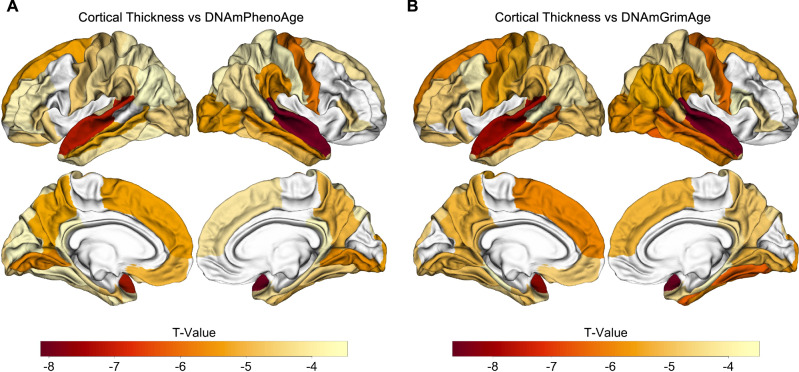 DNA methylation age from peripheral blood predicts progression to Alzheimer's disease, white matter disease burden, and cortical atrophy.