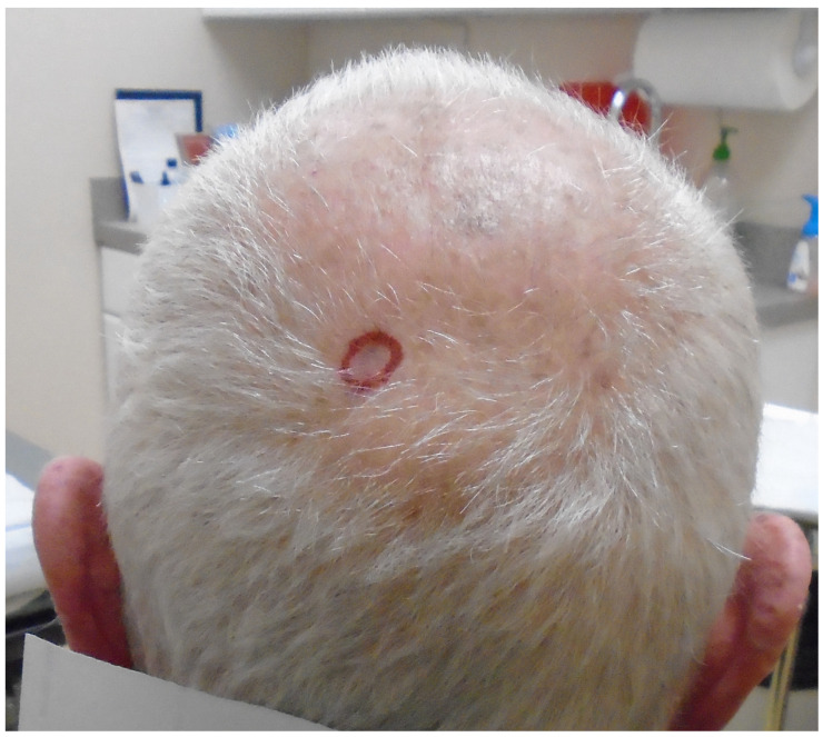 Asteroid Shower: Cutaneous Silica Granuloma with Asteroid Bodies.