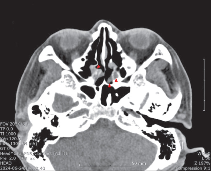 Hemicrania continua with rhinosinusitis: a case report.