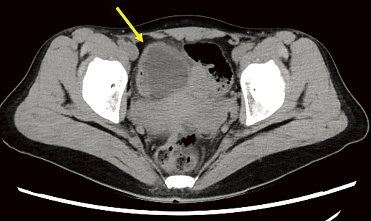 Adult Cystic Intestinal Duplication of the Ileum Laparoscopically Resected after Preoperative Diagnosis with Cine Magnetic Resonance Imaging and Abdominal Ultrasound: A Case Report.