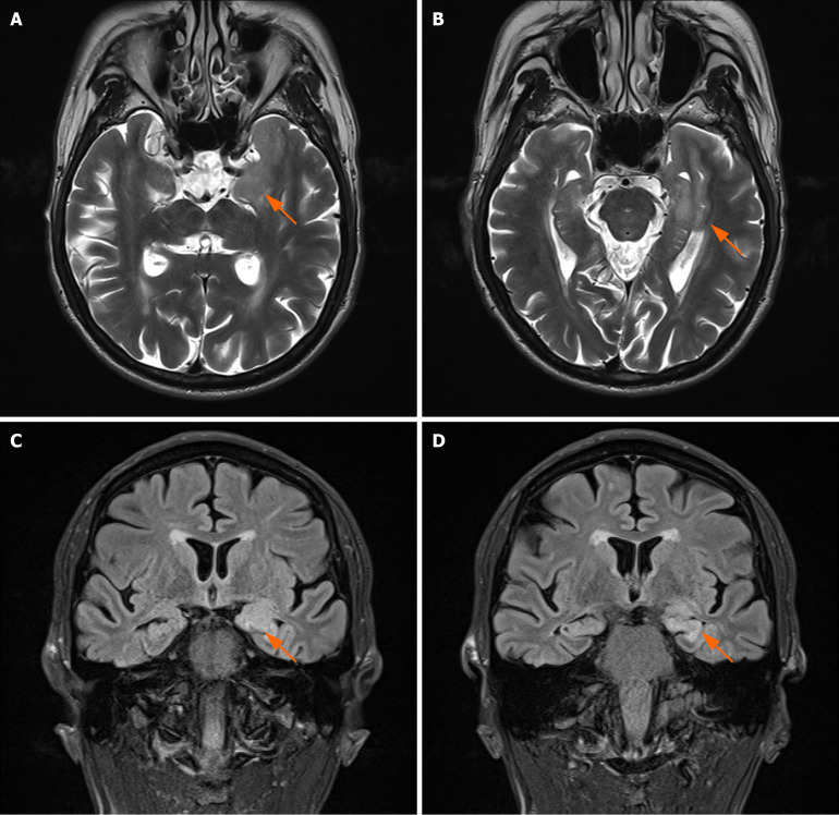 Rare mixed dementia: A case report.