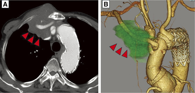 Invasion of Diffuse Large B-Cell Lymphoma to Right Axillary Arterial Graft.