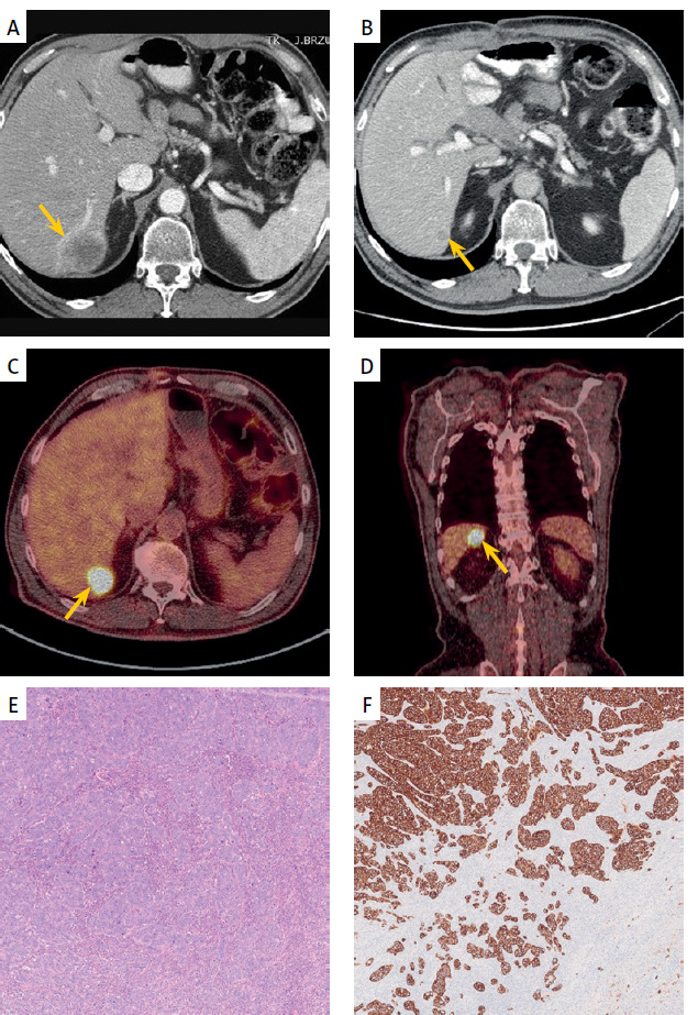 Multimodal treatment for long-term survival in ampullary adenocarcinoma metastatic to the liver.