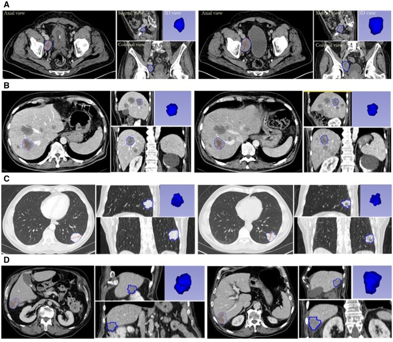 Comparing quantitative imaging biomarker alliance volumetric CT classifications with RECIST response categories.