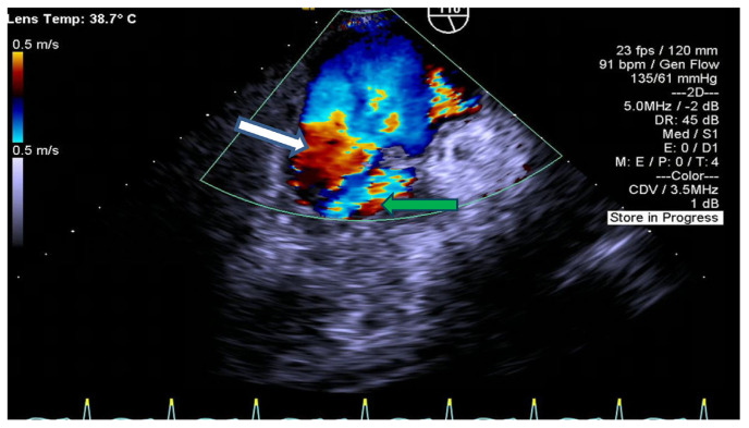 A Rare Case of Infective Endocarditis Caused by <i>Aerococcus urinae</i>.