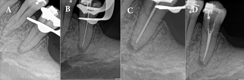 Mental Nerve Paresthesia, a Complication of Anesthesia in Non-surgical Endodontic Treatment: A Case Report .