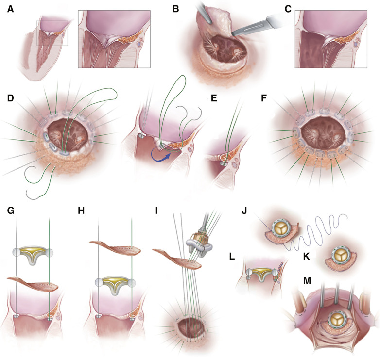 "A Bridge-over-the Bar": A Novel Strategy to Prevent Paravalvular Regurgitation during Mitral Valve Replacement for Severe Mitral Annular Calcifications.