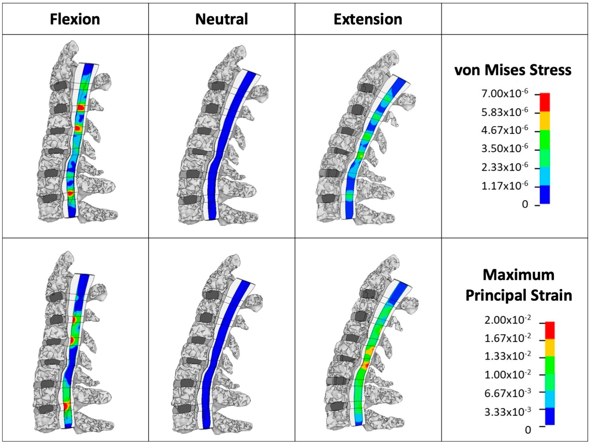 Intramedullary Stress and Strain Correlate with Neurological Dysfunction in Degenerative Cervical Myelopathy.