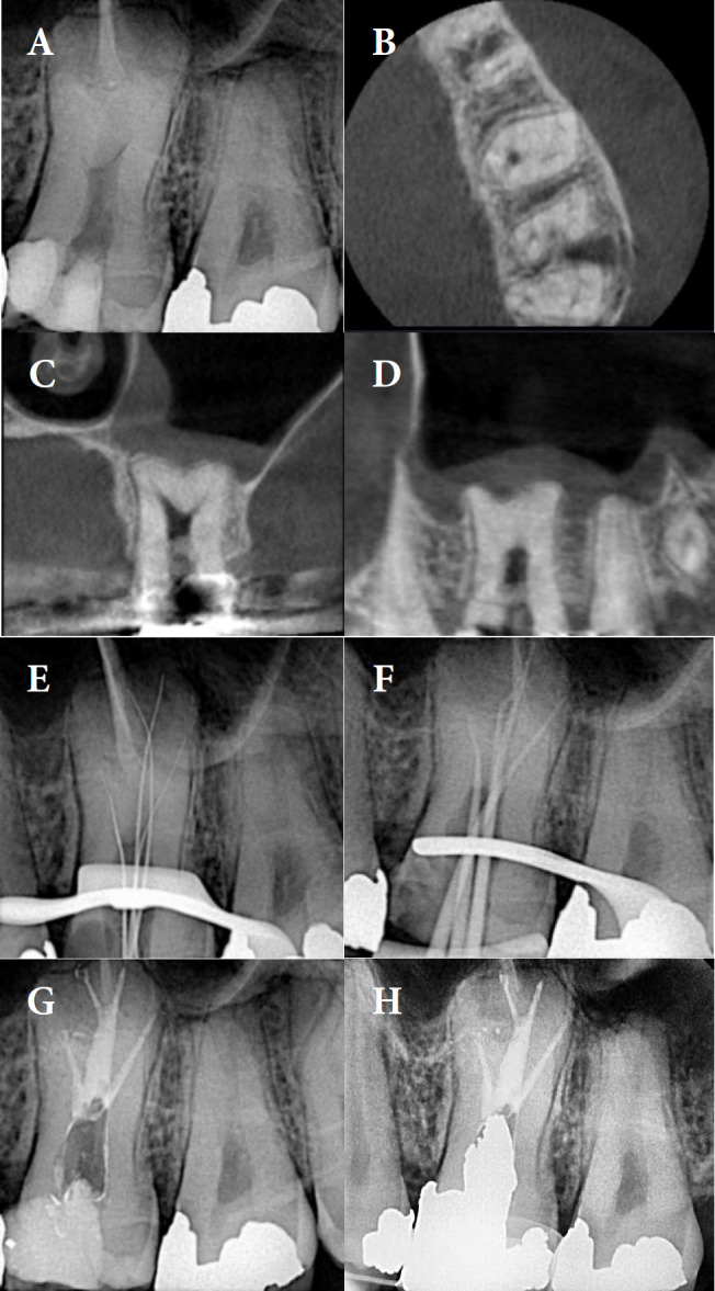 Endodontic Management of Hypertaurodontic Teeth: A Report of Three Cases.