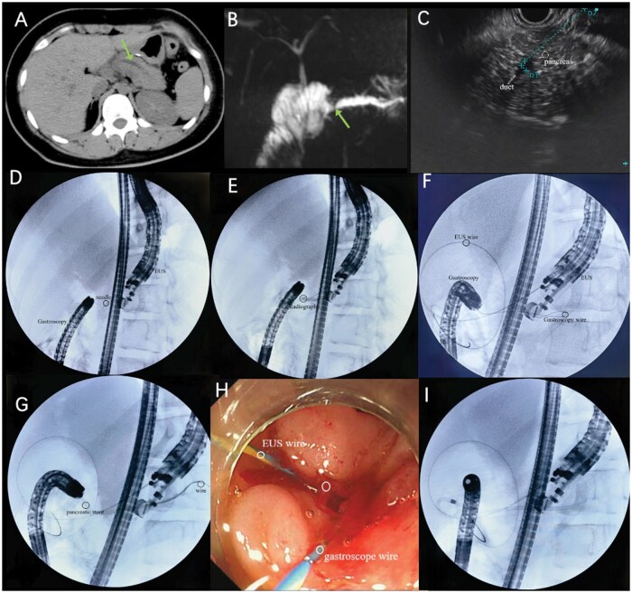 Technical challenge of EUS-guided pancreatic duct drainage with gastroscopy for pediatric pancreaticojejunostomy stricture.