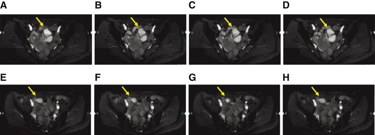 Adult Cystic Intestinal Duplication of the Ileum Laparoscopically Resected after Preoperative Diagnosis with Cine Magnetic Resonance Imaging and Abdominal Ultrasound: A Case Report.
