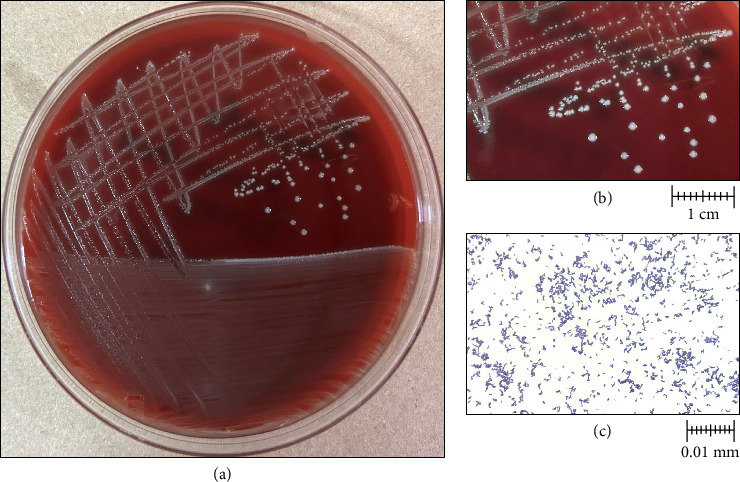 Polymicrobial Osteomyelitis in a Patient With Isolation of <i>Trueperella bernardiae</i>: A Case Report and Literature Review.