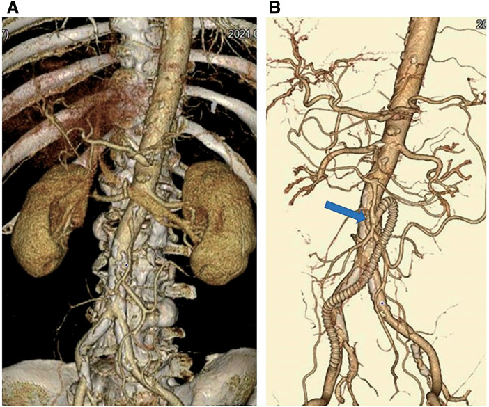 Surgical Outcomes of the Boat-Form Vein Cuff Technique in Peripheral Artery Bypass Grafting.