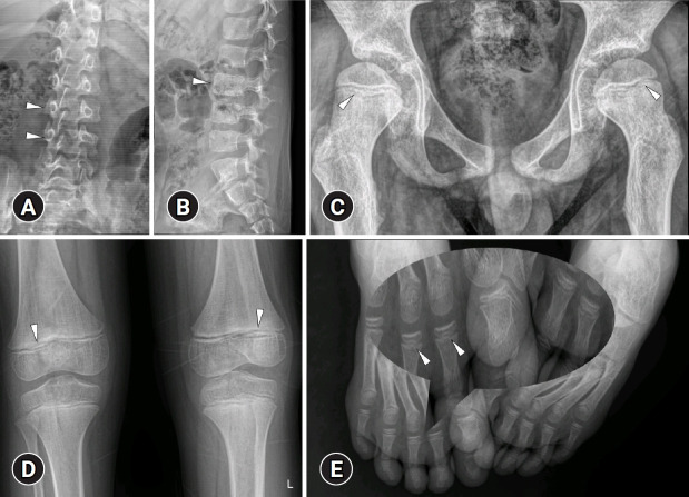 Spondyloenchondrodysplasia with immune dysregulation: an under-the-radar cause of spasticity.