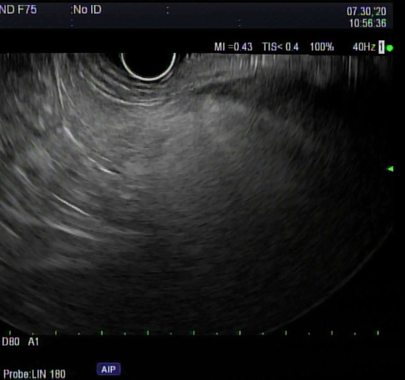 Fatty pancreas on EUS: Risk factors, correlation with CT/MRI, and implications for pancreatic cancer screening.