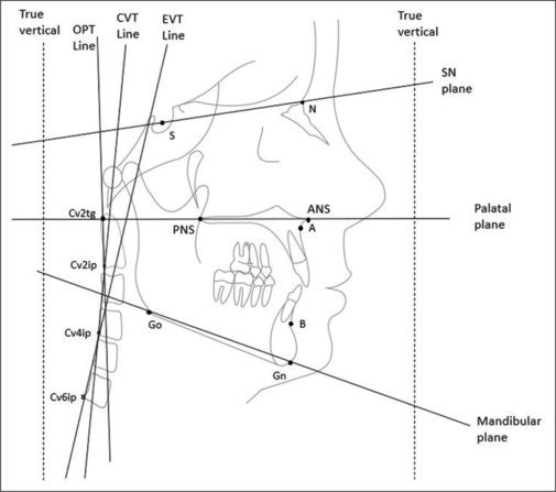 Change in cervical posture after maxillary protraction with facemask therapy: A retrospective study.