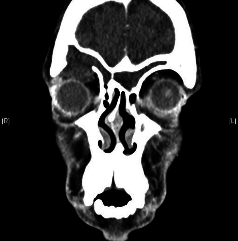 Do Variations in Frontal Recess Anatomy Predispose to Mucocele Formation?