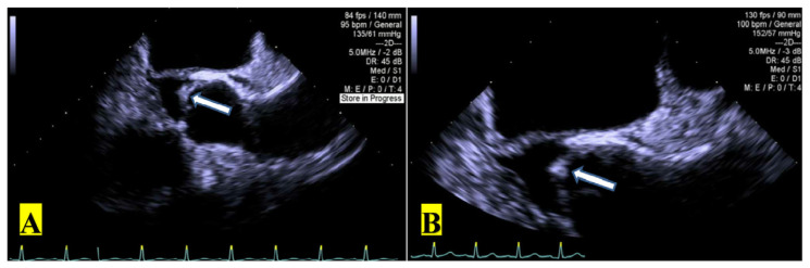 A Rare Case of Infective Endocarditis Caused by <i>Aerococcus urinae</i>.