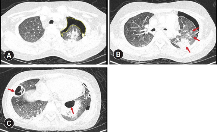 Bilateral spontaneous pneumothorax in lupus erythematosus and the role of low-dose intravenous immunoglobulin.