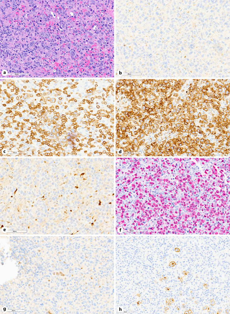 Nodal T-Cell Lymphoma Transdifferentiated from Mantle Cell Lymphoma with Epstein-Barr Virus Infection.
