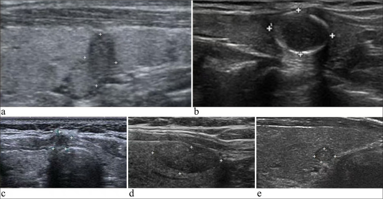 Histopathological findings of 687 thyroid nodules, suspicious for malignancy on ultrasound, with an indeterminate cytopathological diagnosis after the combination of the Bethesda System and <i>BRAF</i> mutation status.