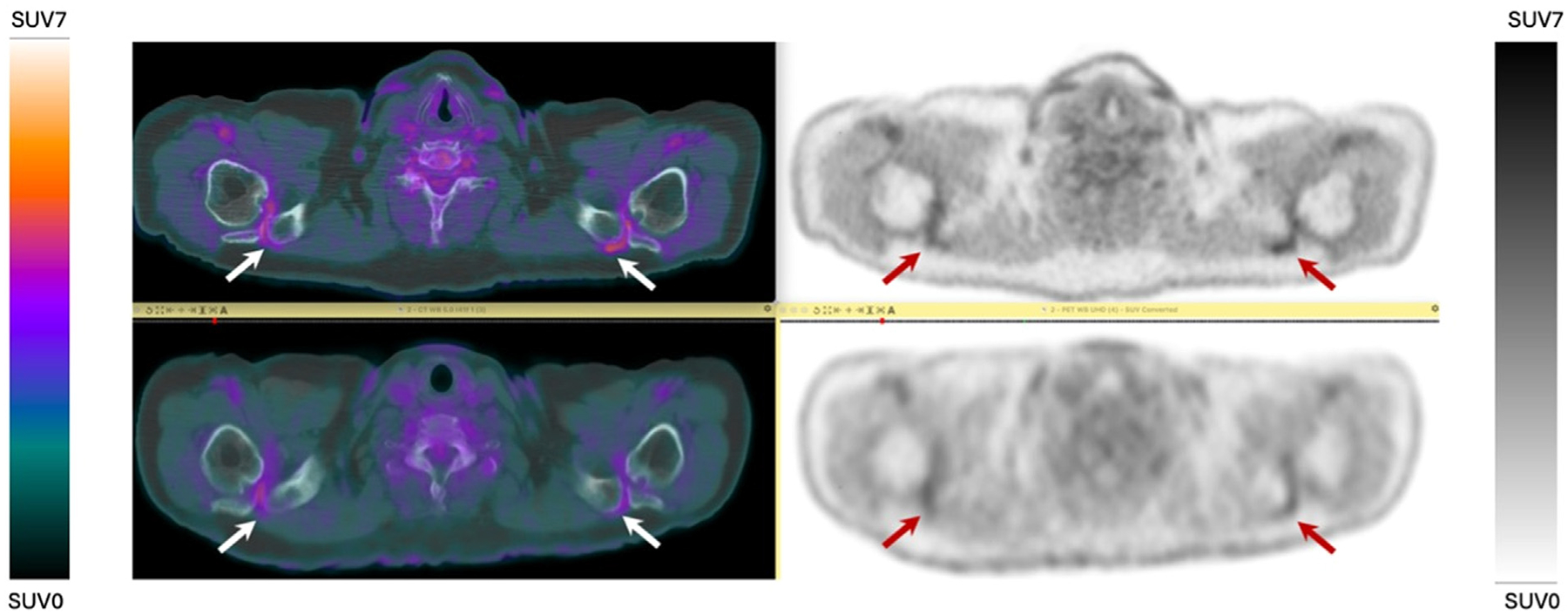 Role of Total Body PET/CT in Inflammatory Disorders