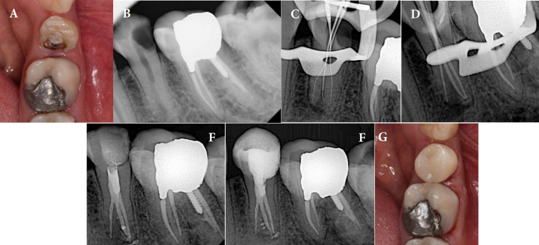 Endodontic Management of Hypertaurodontic Teeth: A Report of Three Cases.