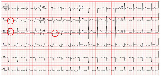 Rare Case of Acute Pancreatitis Presenting With ST-Segment Elevation.