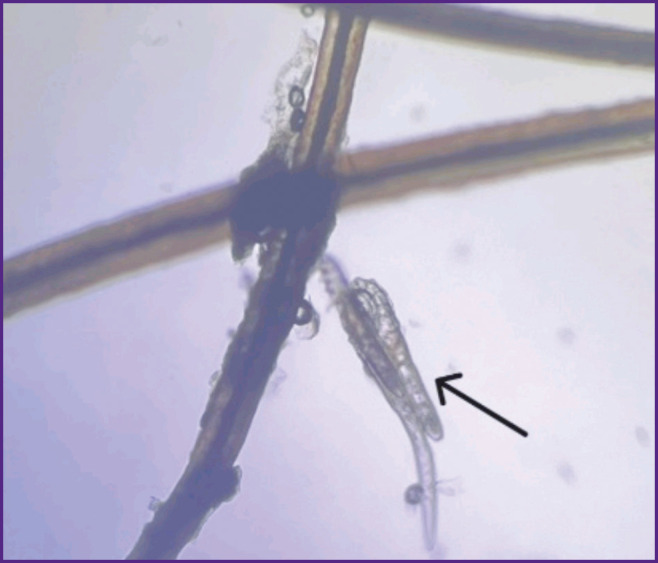 Modern Technologies in <i>Demodex</i> Blepharitis Diagnosis and Therapy (Review).
