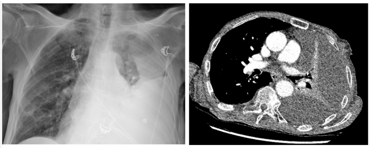 Pancreatopleural fistula: A rare cause of recurrent pleural effusion