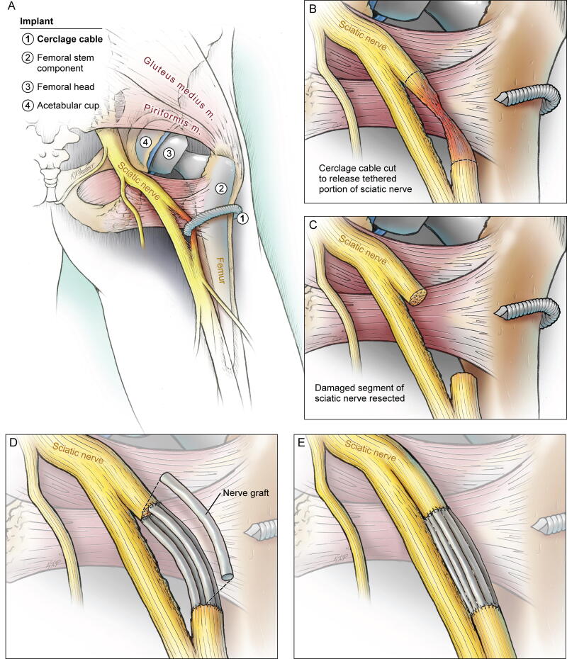 Profound Neuropathy after Penetrating Transection of the Sciatic Nerve by Femoral Cerclage Wire: Illustrative Case and Management Strategy.