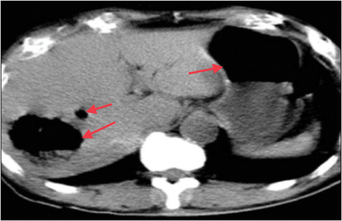 A Diagnostic Dilemma of Emphysematous Liver Abscess with Gas under the Diaphragm: A Case Report and Review of Literature.