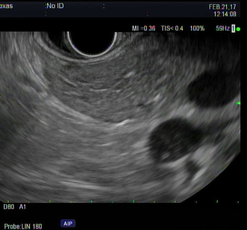 Fatty pancreas on EUS: Risk factors, correlation with CT/MRI, and implications for pancreatic cancer screening.