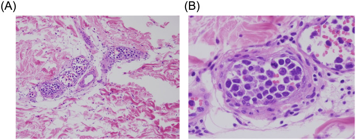 Long-term remission in a patient with NK/T cell intravascular lymphoma with autologous hematopoietic cell transplantation.