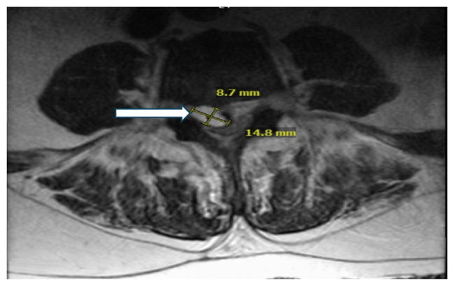 A Rare Case of Infective Endocarditis Caused by <i>Aerococcus urinae</i>.