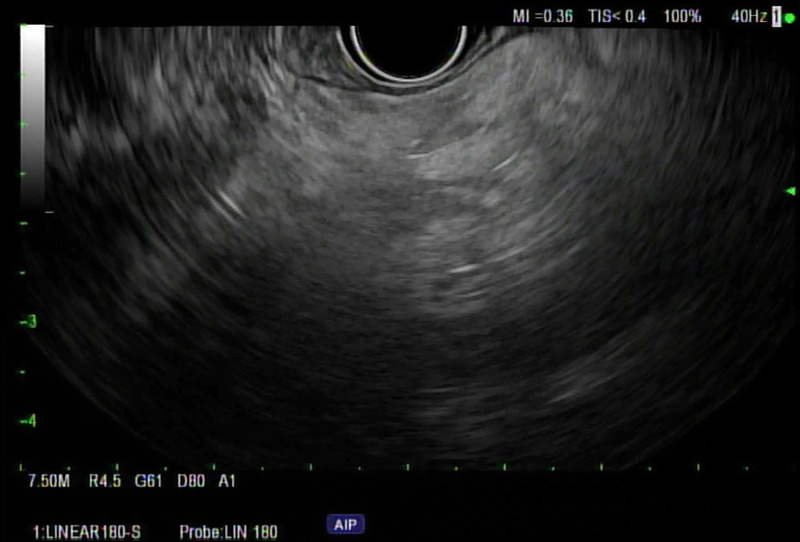 Fatty pancreas on EUS: Risk factors, correlation with CT/MRI, and implications for pancreatic cancer screening.