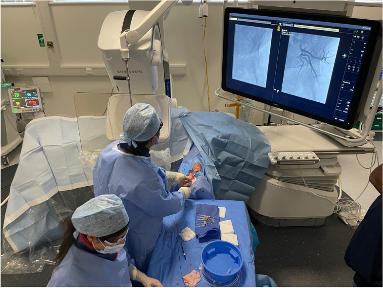 A modified technique for radial artery access: how interventional radiologists can optimise the cardiologists' technique to suite their procedures.