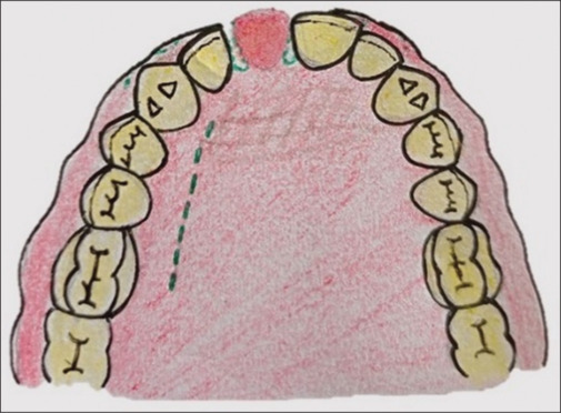 Vascularized interpositional periosteal connective tissue flap: A comprehensive review.